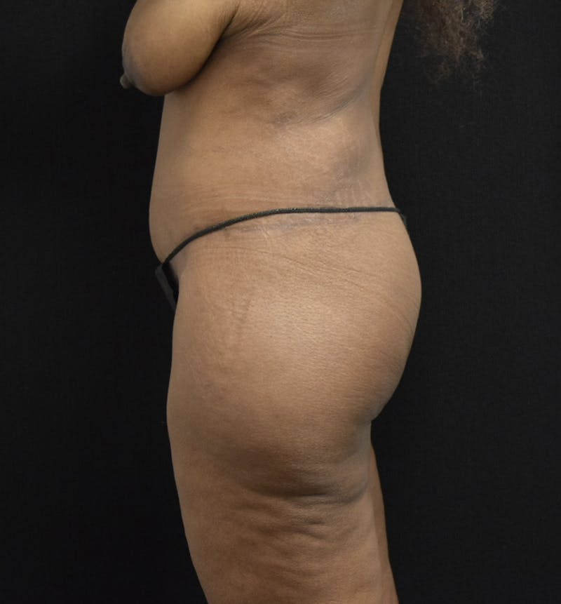 Fat Transfer to Buttock Before & After Gallery - Patient 121235687 - Image 10