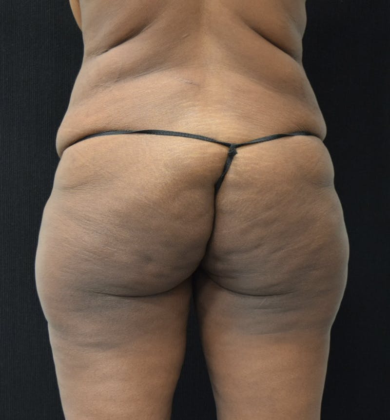 Lower Body Lift Before & After Gallery - Patient 121235672 - Image 9