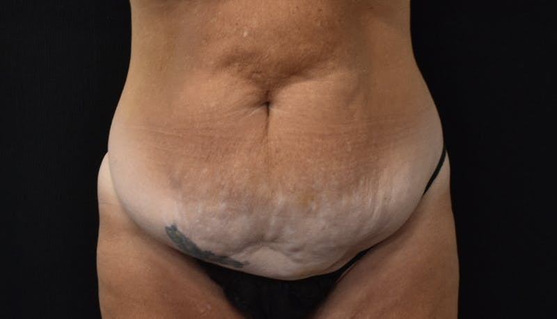 Abdominoplasty Before & After Gallery - Patient 121256885 - Image 1