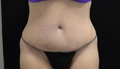 Abdominoplasty Before & After Gallery - Patient 121256885 - Image 2