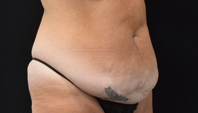 Abdominoplasty Before & After Gallery - Patient 121256885 - Image 3