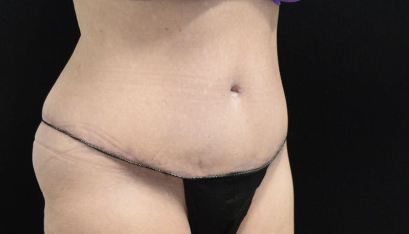 Abdominoplasty Before & After Gallery - Patient 121256885 - Image 4