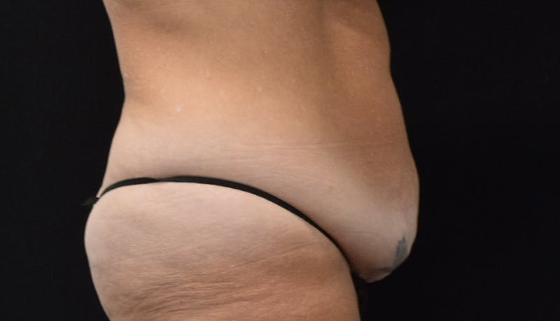 Abdominoplasty Before & After Gallery - Patient 121256885 - Image 5