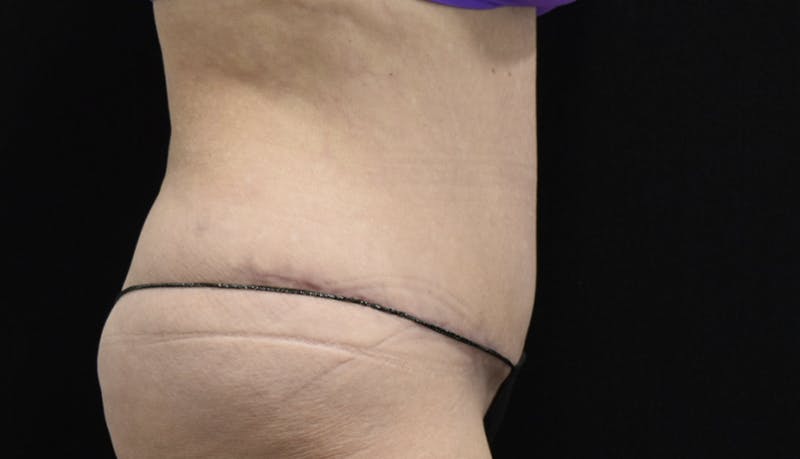Abdominoplasty Before & After Gallery - Patient 121256885 - Image 6