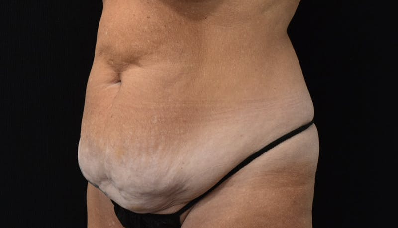 Abdominoplasty Before & After Gallery - Patient 121256885 - Image 7