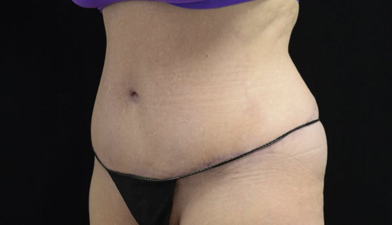 Abdominoplasty Before & After Gallery - Patient 121256885 - Image 8