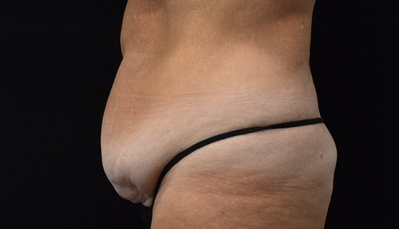 Abdominoplasty Before & After Gallery - Patient 121256885 - Image 9