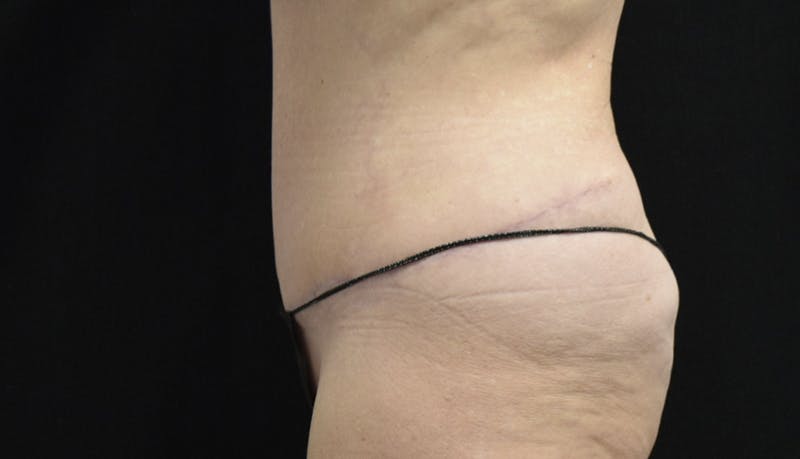 Abdominoplasty Before & After Gallery - Patient 121256885 - Image 10