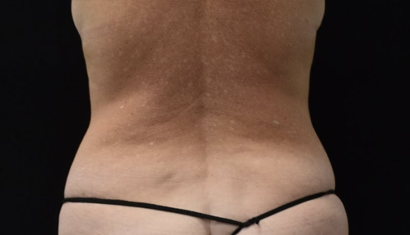 Abdominoplasty Before & After Gallery - Patient 121256885 - Image 11