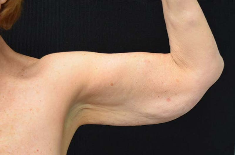 Brachioplasty Before & After Gallery - Patient 121359391 - Image 7