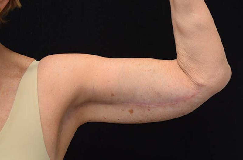 Brachioplasty Before & After Gallery - Patient 121359391 - Image 8