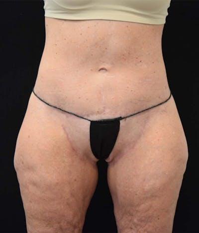 Lower Body Lift Before & After Gallery - Patient 121359621 - Image 2
