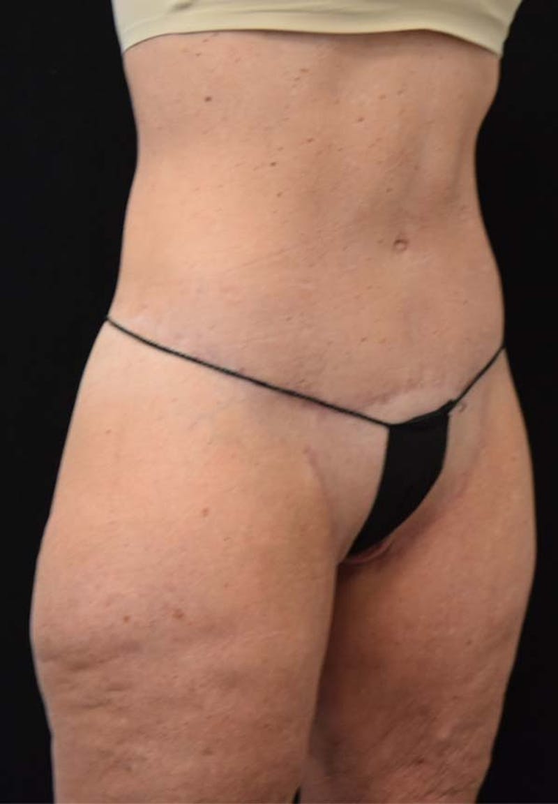 Lower Body Lift Before & After Gallery - Patient 121359621 - Image 4