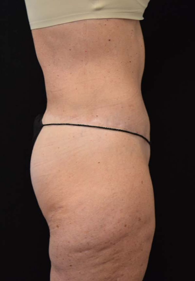 Lower Body Lift Before & After Gallery - Patient 121359621 - Image 6