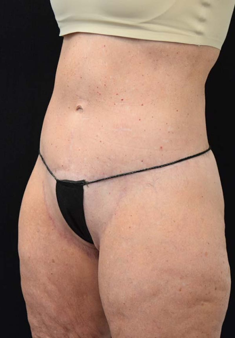 Lower Body Lift Before & After Gallery - Patient 121359621 - Image 12