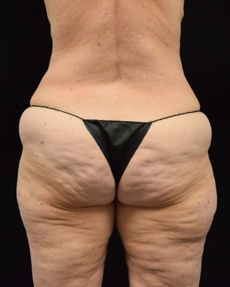 Lower Body Lift Before & After Gallery - Patient 121359621 - Image 7