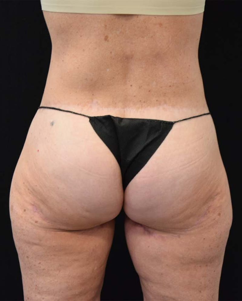 Lower Body Lift Before & After Gallery - Patient 121359621 - Image 8