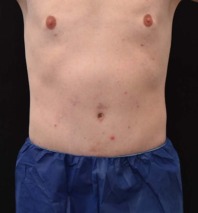 Male Lower Body Lift Before & After Gallery - Patient 148037534 - Image 2
