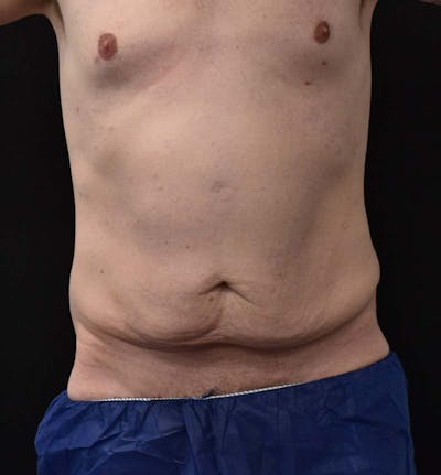 Male Lower Body Lift Before & After Gallery - Patient 148037534 - Image 1