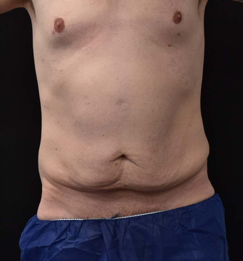 Male Lower Body Lift Before & After Gallery - Patient 148037534 - Image 1
