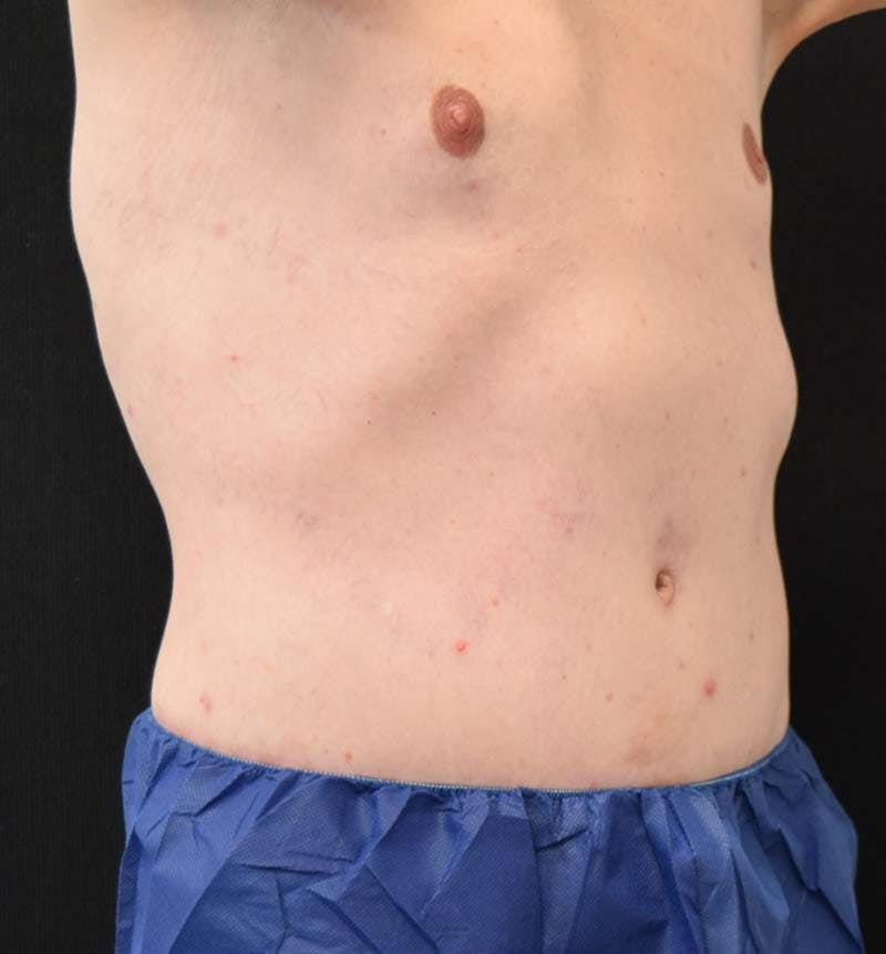 Male Lower Body Lift Before & After Gallery - Patient 148037534 - Image 4