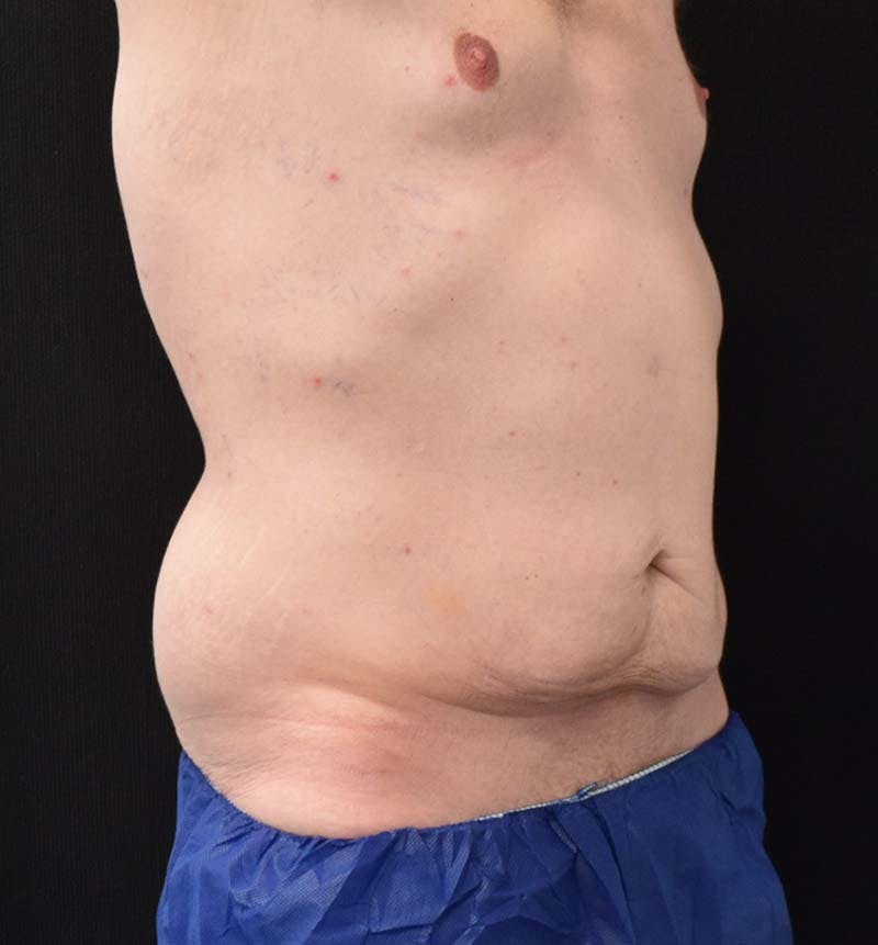 Male Lower Body Lift Before & After Gallery - Patient 148037534 - Image 3