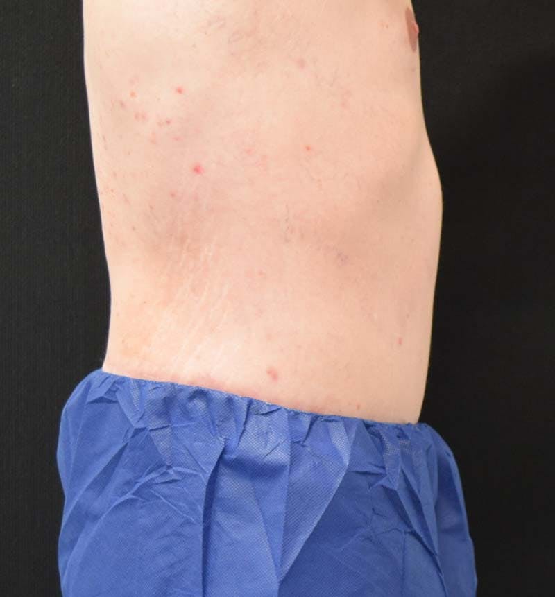 Male Lower Body Lift Before & After Gallery - Patient 148037534 - Image 6