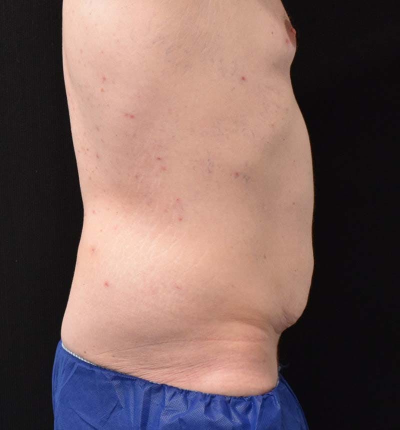 Male Lower Body Lift Before & After Gallery - Patient 148037534 - Image 5