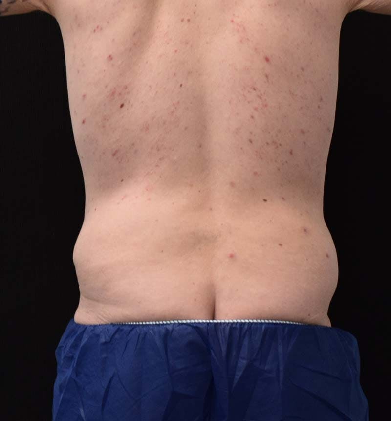 Male Lower Body Lift Before & After Gallery - Patient 148037534 - Image 7