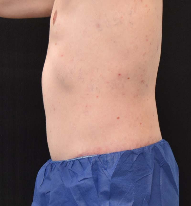 Male Lower Body Lift Before & After Gallery - Patient 148037534 - Image 10