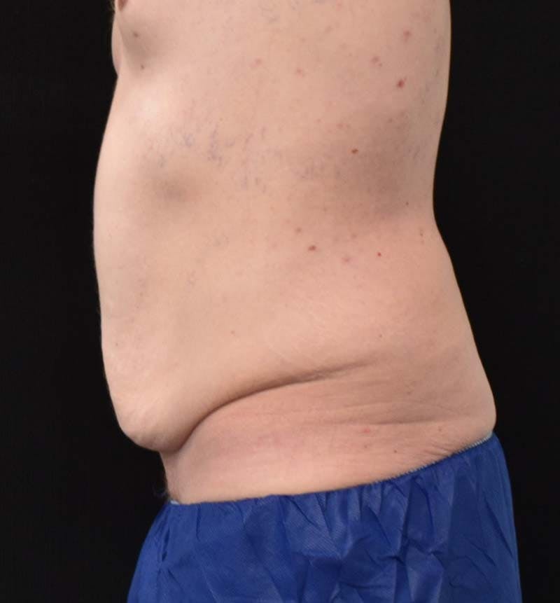 Male Lower Body Lift Before & After Gallery - Patient 148037534 - Image 9