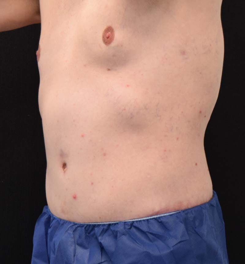 Male Lower Body Lift Before & After Gallery - Patient 148037534 - Image 12