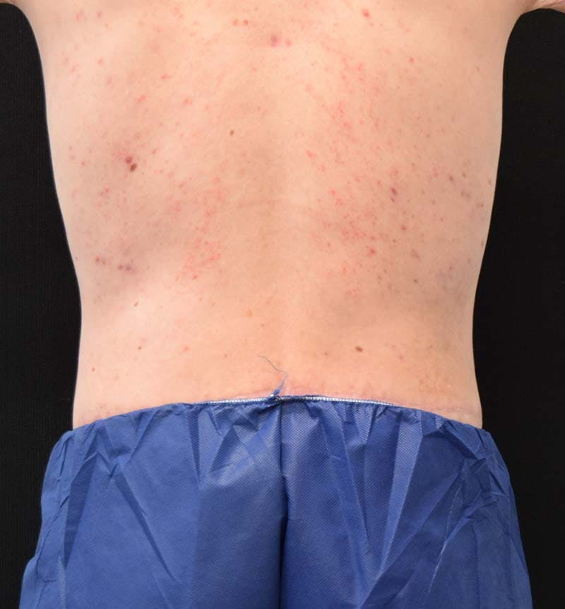 Male Lower Body Lift Before & After Gallery - Patient 148037534 - Image 8