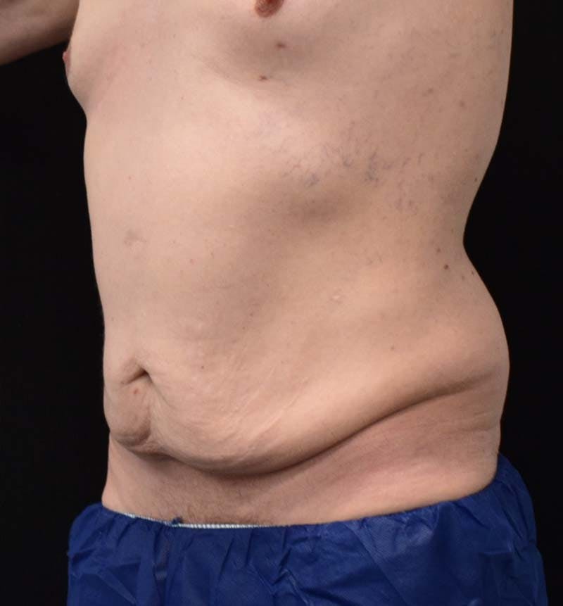 Male Lower Body Lift Before & After Gallery - Patient 148037534 - Image 11