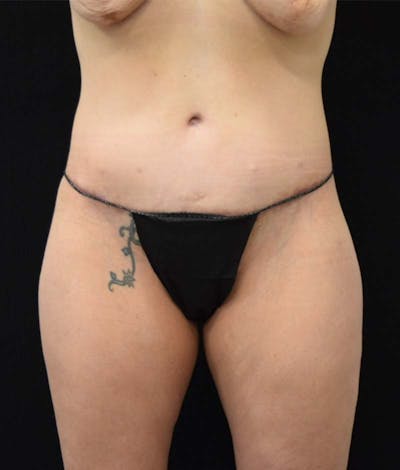Lower Body Lift Before & After Gallery - Patient 121562978 - Image 2