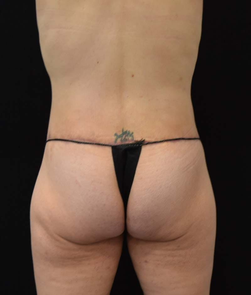 Lower Body Lift Before & After Gallery - Patient 121562978 - Image 6