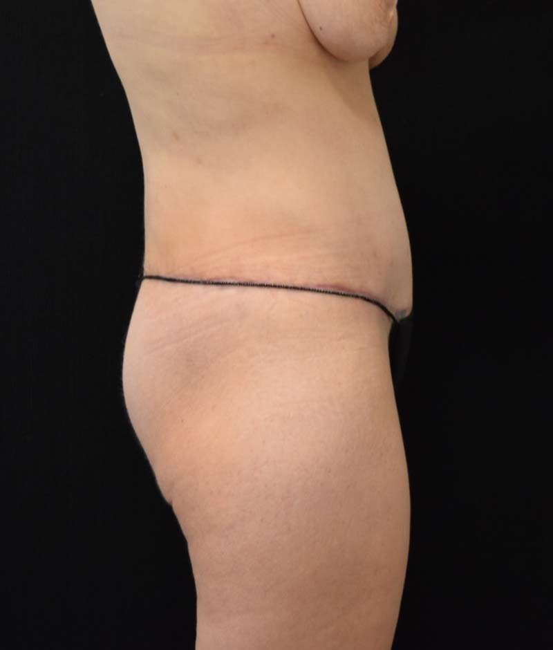 Lower Body Lift Before & After Gallery - Patient 121562978 - Image 8