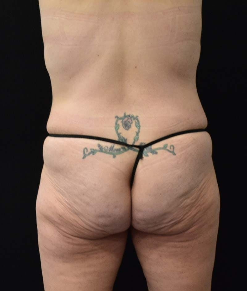 Lower Body Lift Before & After Gallery - Patient 121562978 - Image 5