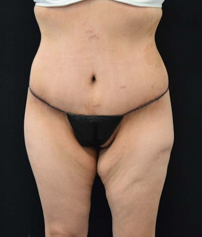 Lower Body Lift Before & After Gallery - Patient 121620220 - Image 2