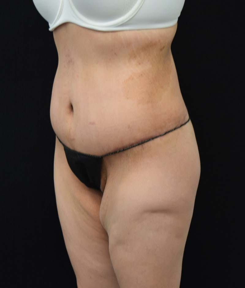 Lower Body Lift Before & After Gallery - Patient 121620220 - Image 4