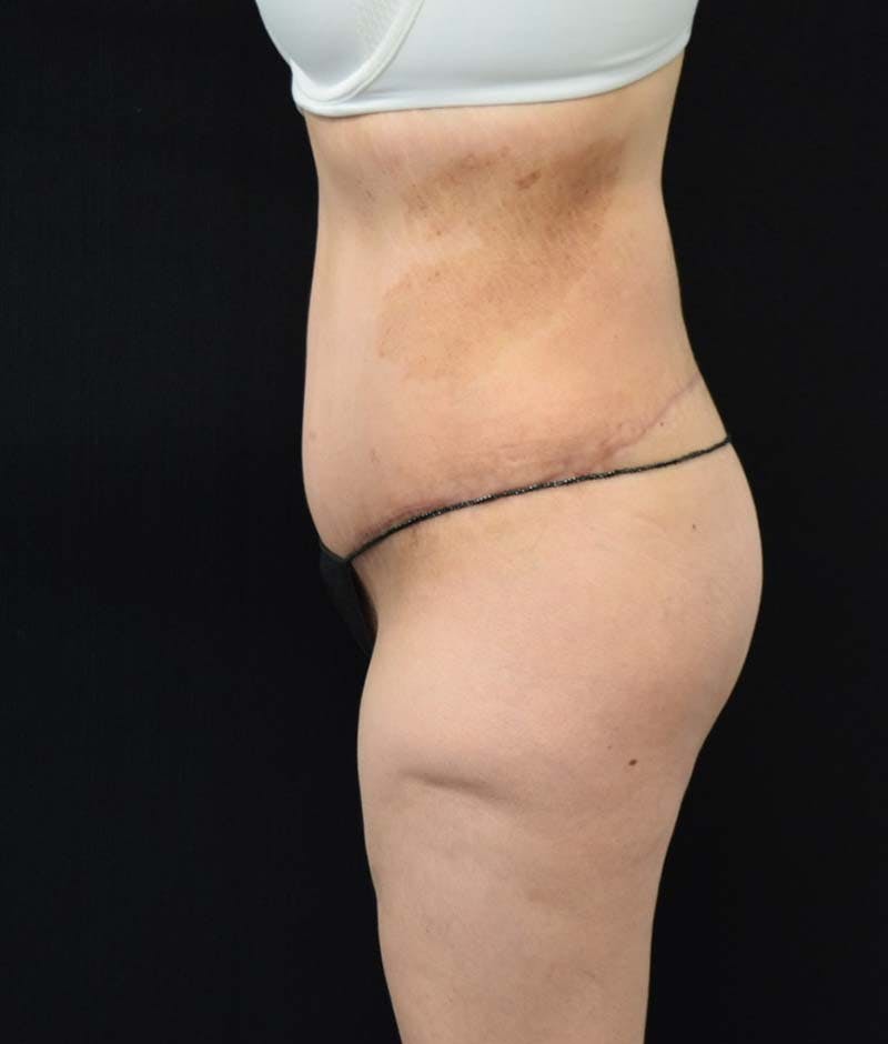 Lower Body Lift Before & After Gallery - Patient 121620220 - Image 6