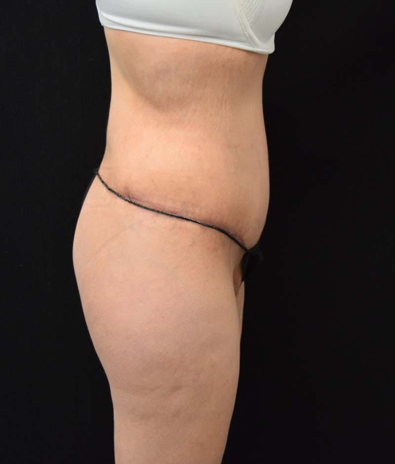 Lower Body Lift Before & After Gallery - Patient 121620220 - Image 10