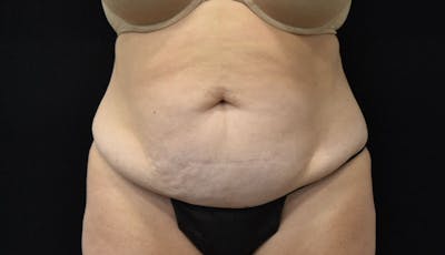 Abdominoplasty Before & After Gallery - Patient 121686073 - Image 1