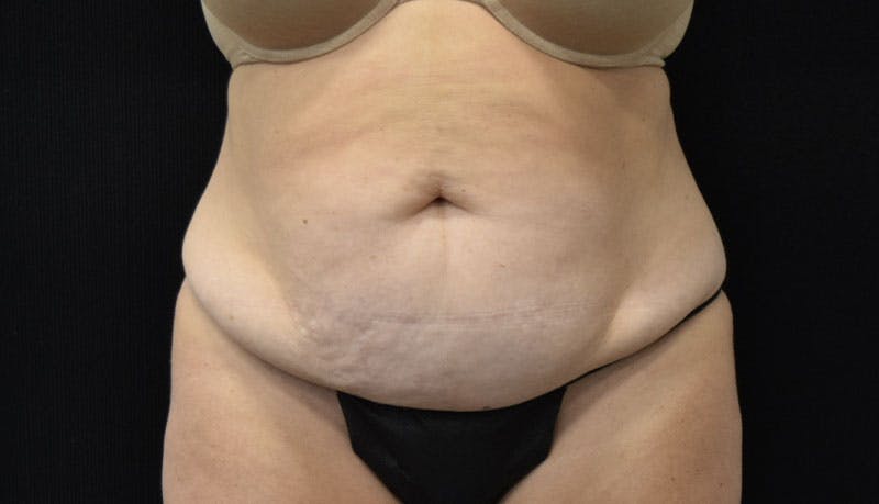Abdominoplasty Before & After Gallery - Patient 121686073 - Image 1