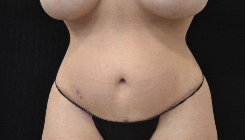 Abdominoplasty Before & After Gallery - Patient 121686073 - Image 2