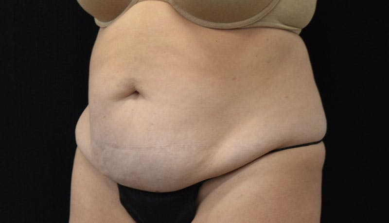 Abdominoplasty Before & After Gallery - Patient 121686073 - Image 3