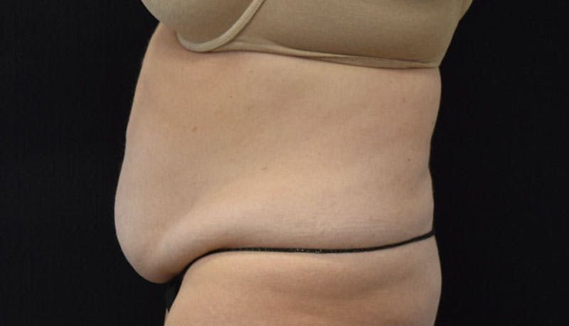 Abdominoplasty Before & After Gallery - Patient 121686073 - Image 5