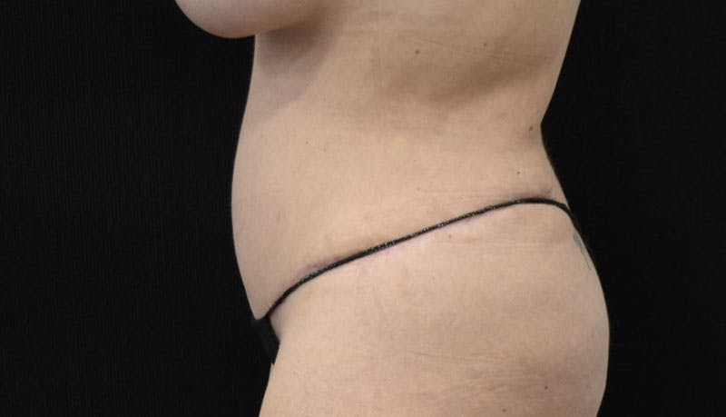 Abdominoplasty Before & After Gallery - Patient 121686073 - Image 6