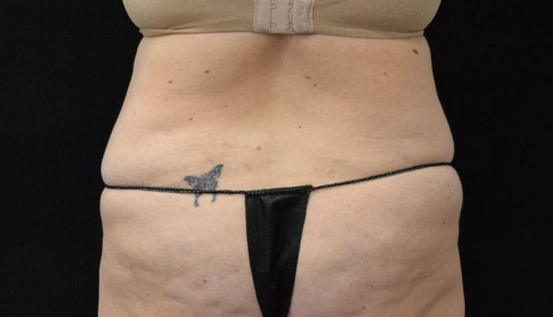 Abdominoplasty Before & After Gallery - Patient 121686073 - Image 7