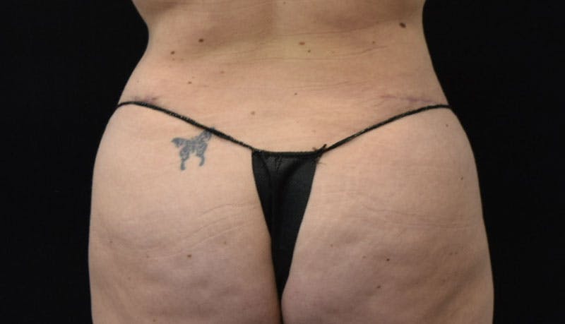 Abdominoplasty Before & After Gallery - Patient 121686073 - Image 8